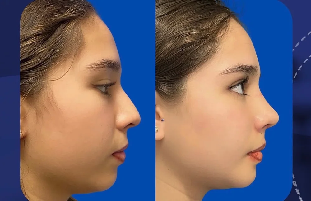 Resultado real de rinoplastia, comparativo de perfil