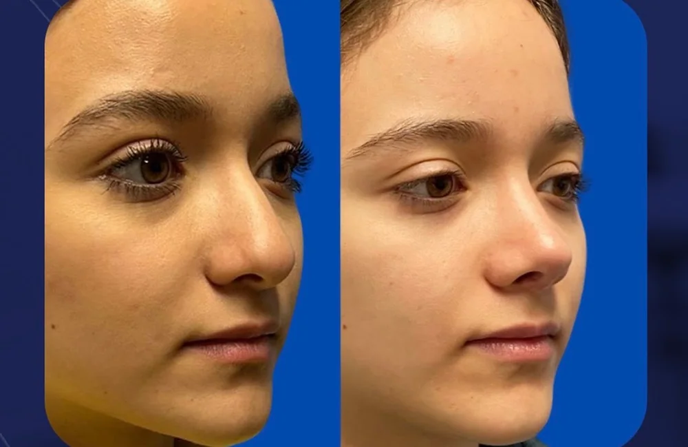 Resultado real de rinoplastia, comparativo tres cuartos